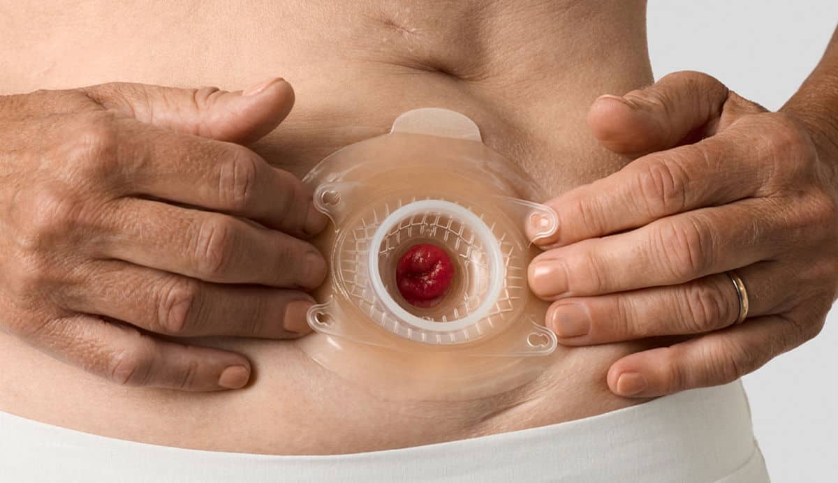 En spegelbild av det peristomala hudplanet genom djup och lutning