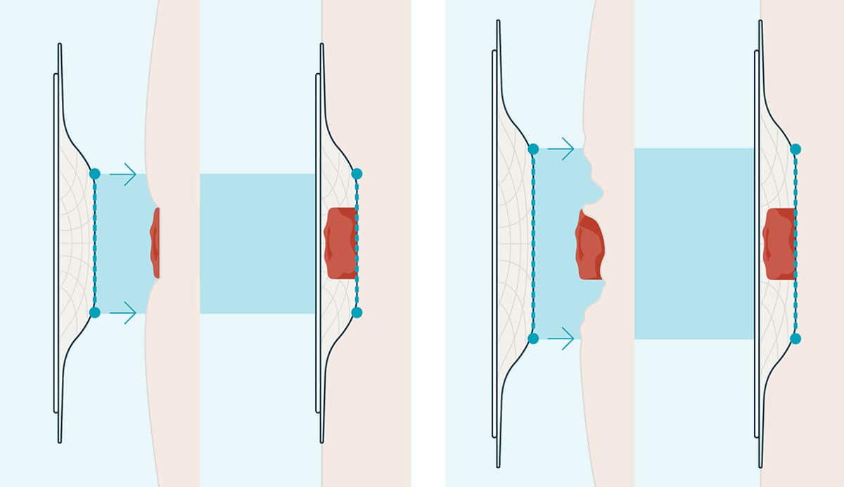 Tryckets lokalisation är avgörande<sup>3</sup>