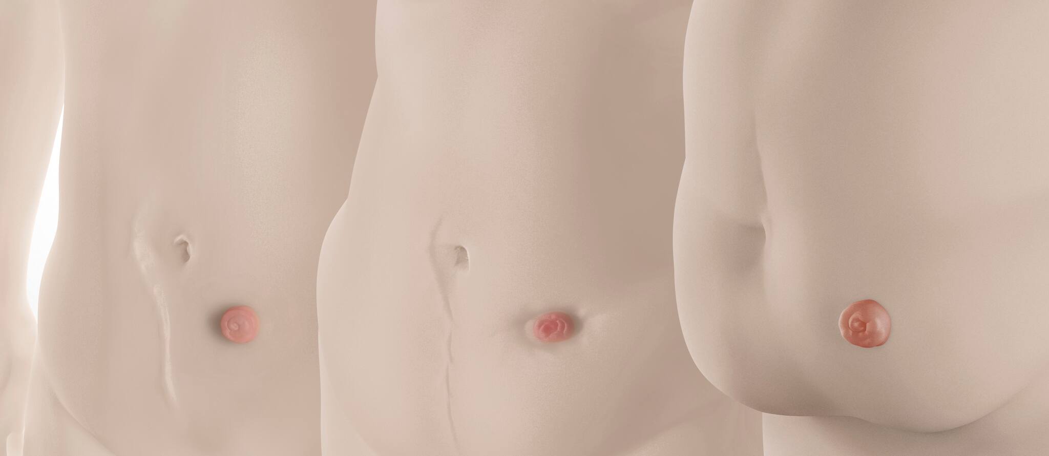 Verktyg för bedömning av peristomal kroppsprofil